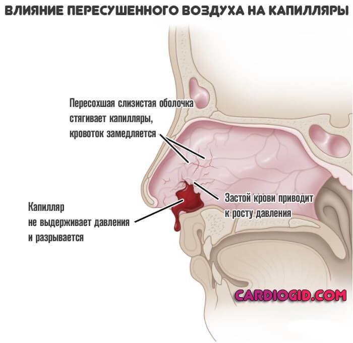 Кровь из носа у ребенка причины (4, 5, 6, 7, 8 лет): почему часто течёт ночью - лечение