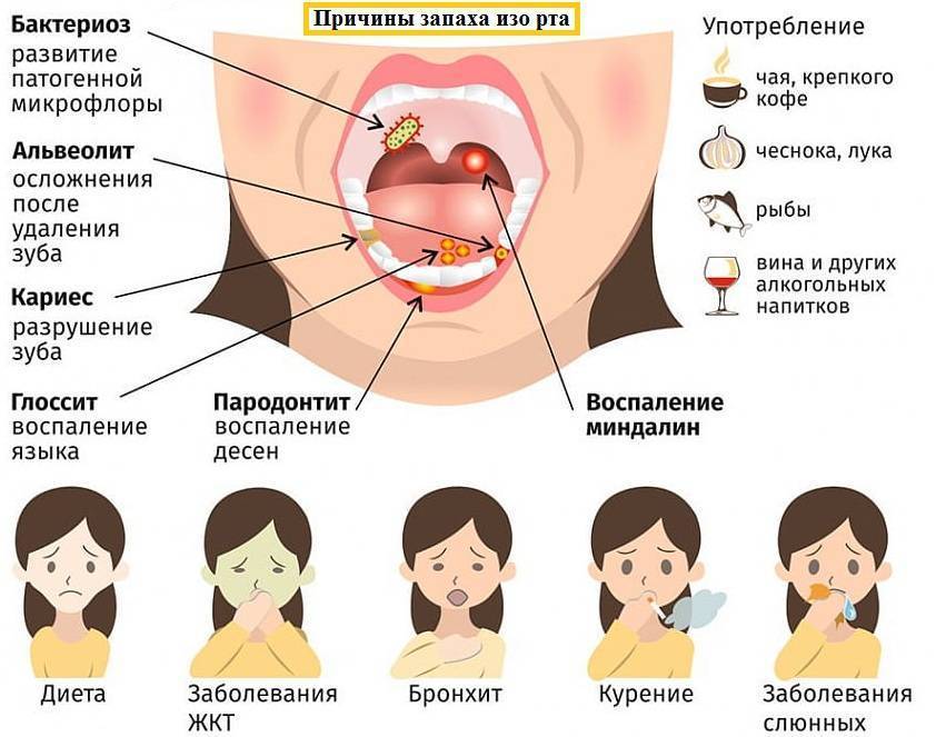 Запах изо рта, причины и лечение сильного неприятного запаха изо рта