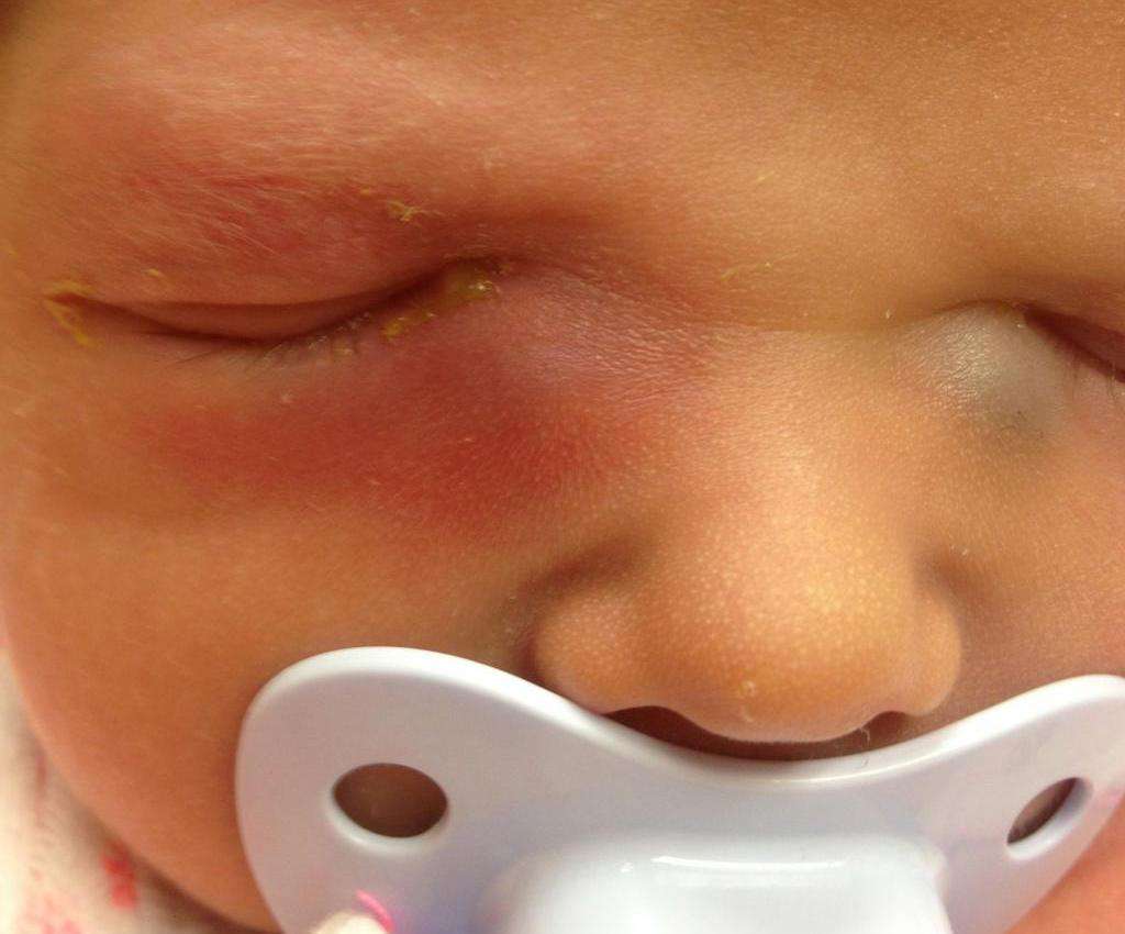 Зондирование слезного канала у новорожденных и детей до года при дакриоцистите