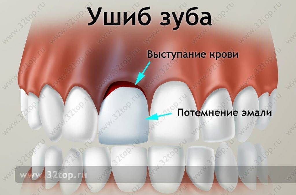 ᐈ синяк после обезболивания зуба: причины появления, чем опасен, как лечить