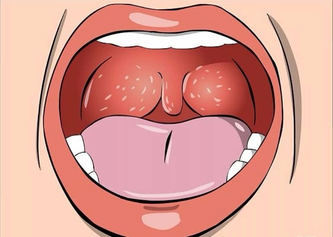 Отек горла при ангине: что делать и как снять боль в горле