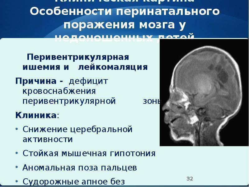 Опухоли головного мозга у детей: важность онконастороженности и особенности диагностики с позиции детского невролога | nasdr
