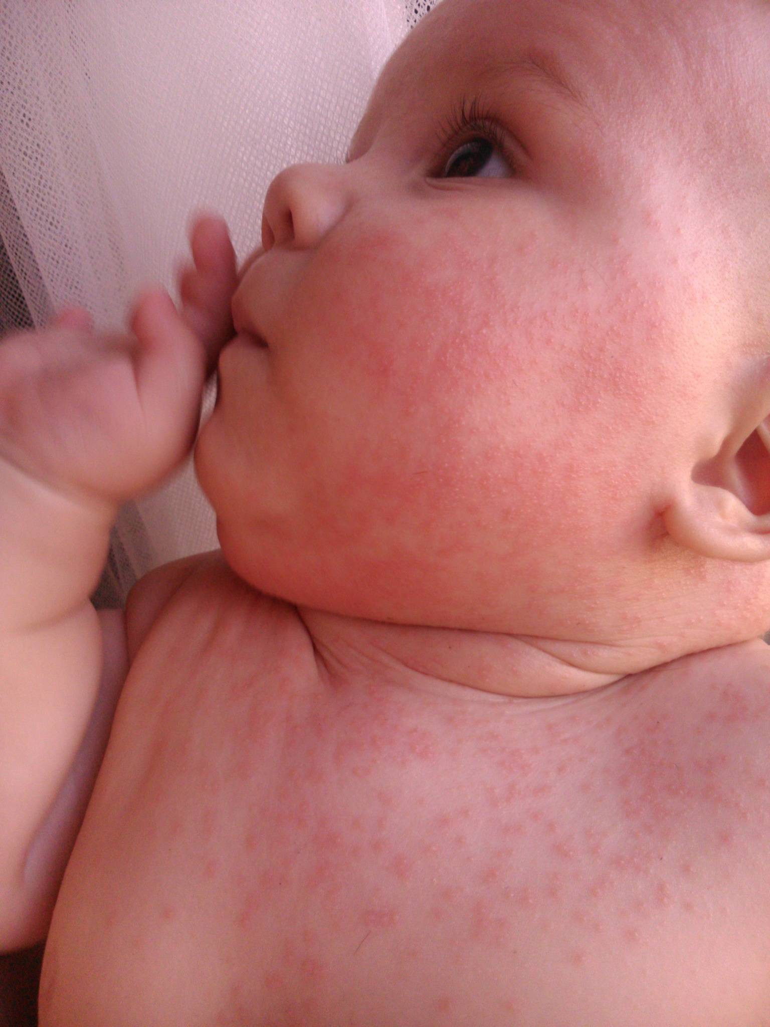 Гормональная сыпь у новорожденных: фото трехнедельных неонатальных прыщиков у детей
