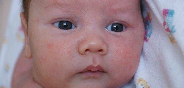 Аллергия на подгузники: как выглядит и что делать | сыпь и покраснения под подгузником у ребенка