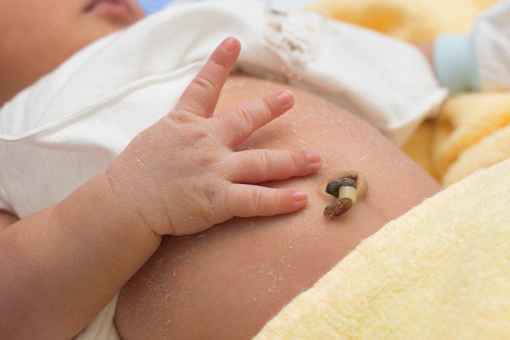 Фунгус пупка у новорожденных: причины и последствия, симптомы с фото и лечение, мнение комаровского