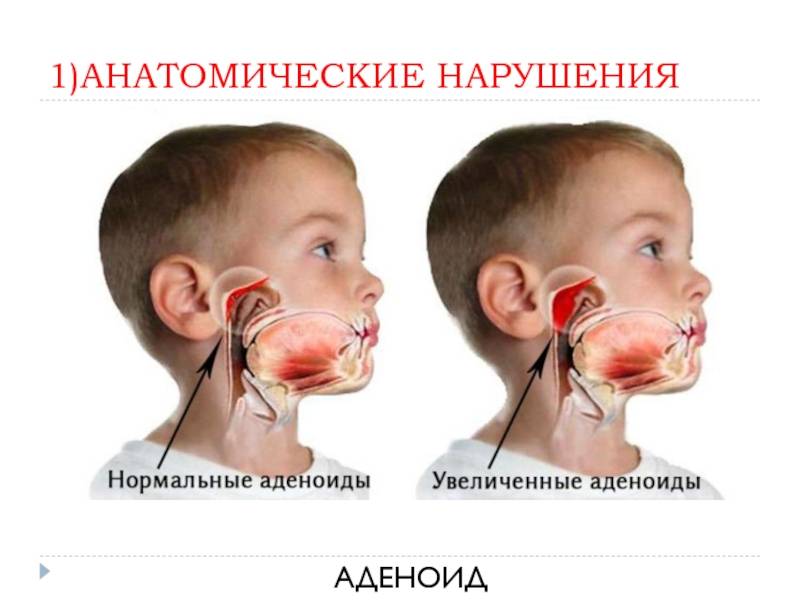 Аденоиды у детей - как проявляются, чем опасны и как лечить?