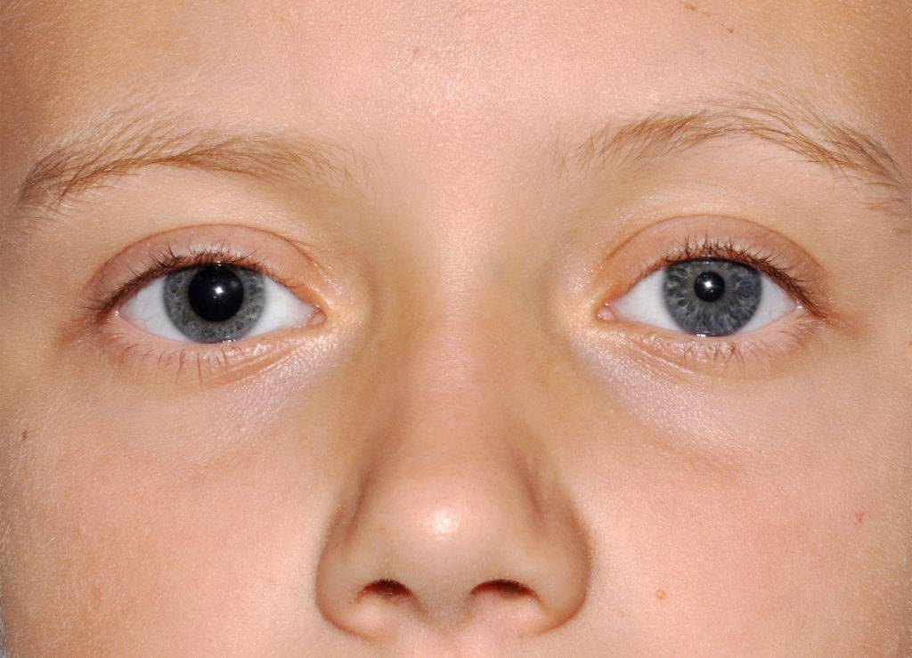 Глаза стали разного размера - причины и лечение на сайте офтальмологического центра "мгк-диагностик" - moscoweyes.ru - сайт офтальмологического центра "мгк-диагностик"