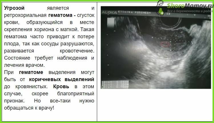 Угроза выкидыша на ранних сроках: как предотвратить