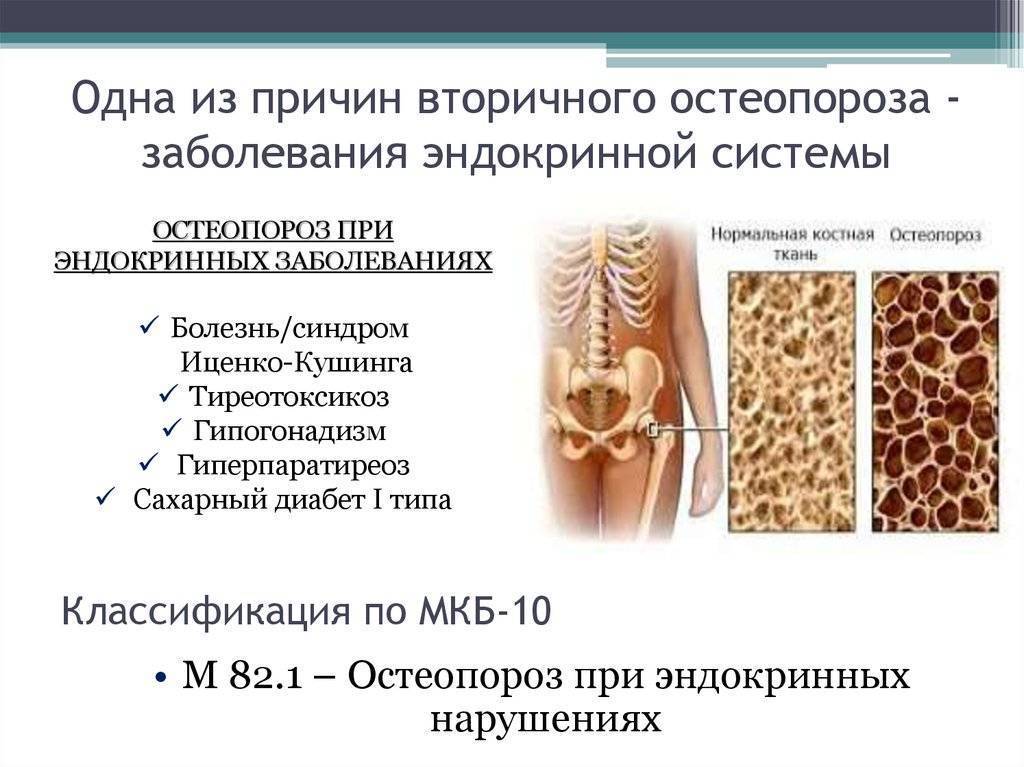 Профилактика остеопороза