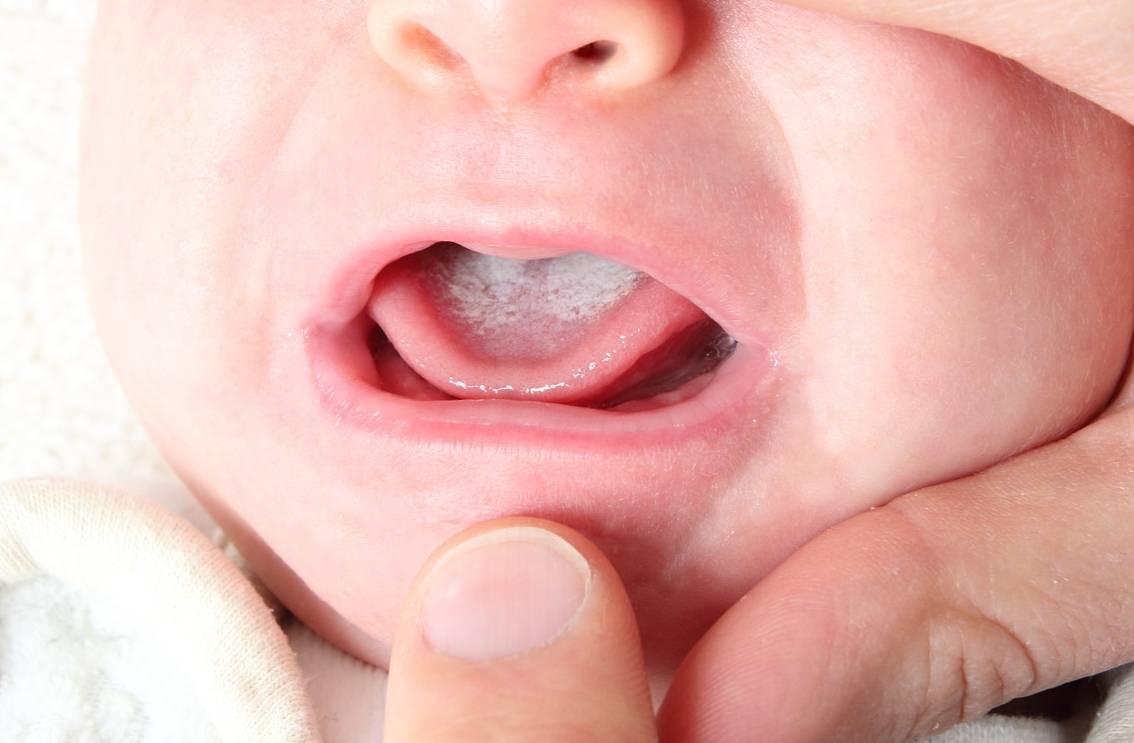 Распознаем и лечим молочницу во рту у новорожденных детей
