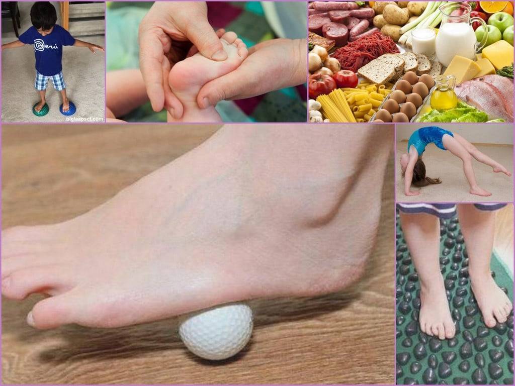 Плоскостопие - причины, симптомы, степени, диагностика. продольное и поперечное плоскостопие. лечение  – массаж, обувь и стельки при плоскостопии, упражнения