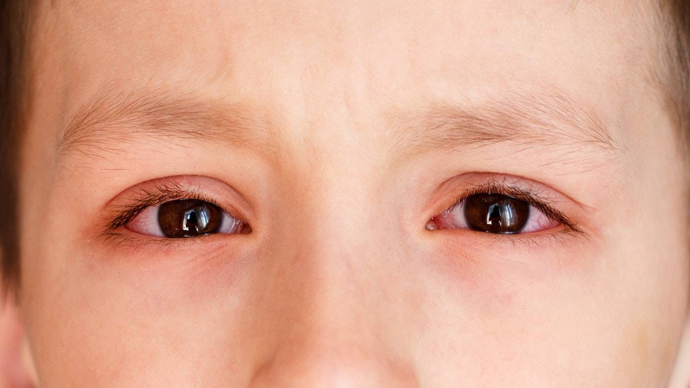 Блефарит у детей - виды и причины, диагностика и лечение | детская офтальмология см-клиники в спб
