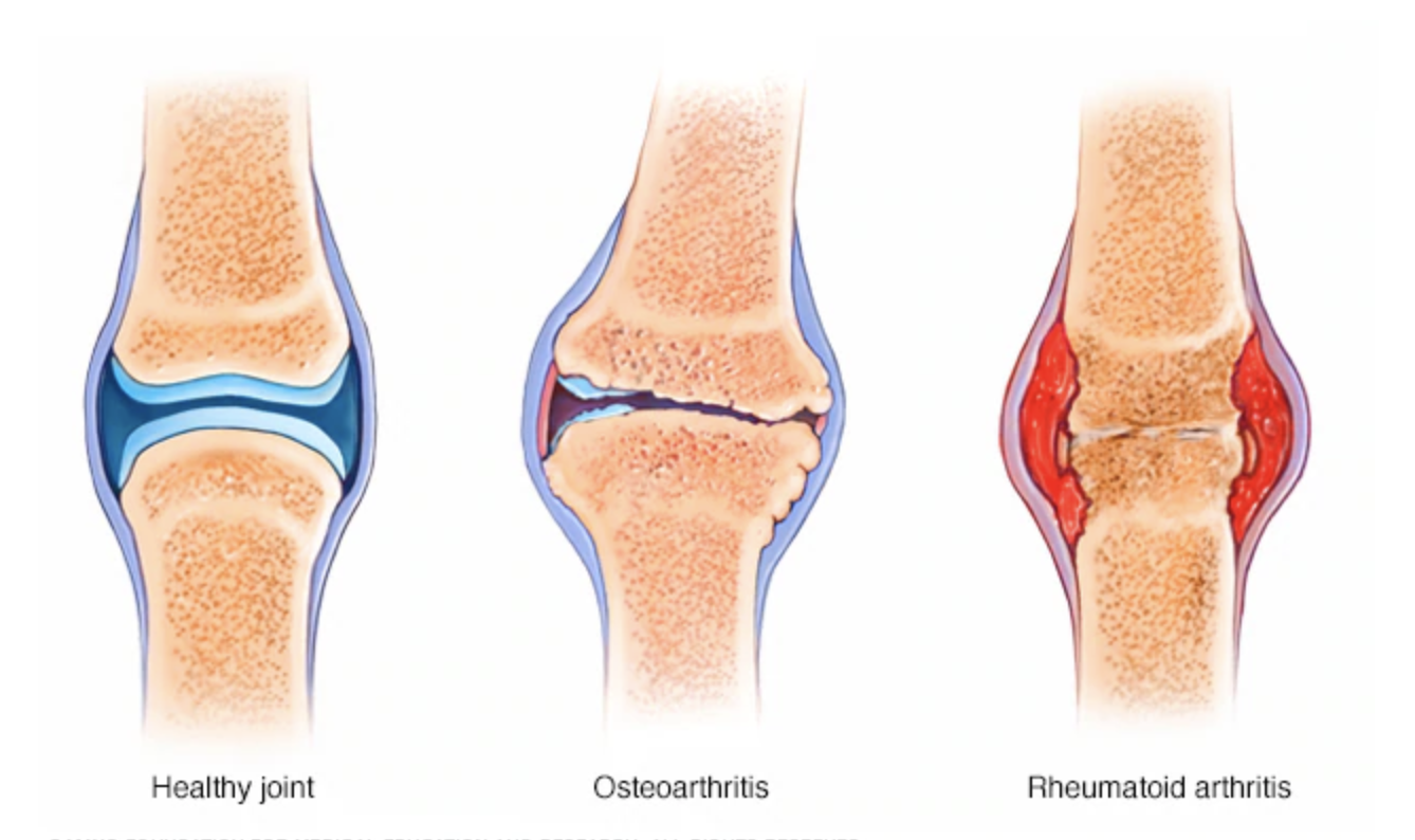 Артрит коленного сустава в домашних условиях. Ревматоидный артрит суставы. Ревматоидный артрит колена. Ревматоидный артрит и остеоартроз.