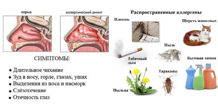 Аллергический ринит у детей: симптомы, причины, 11 советов родителям