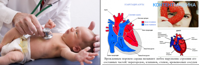 Врожденный порок сердца — факторы риска и способы лечения