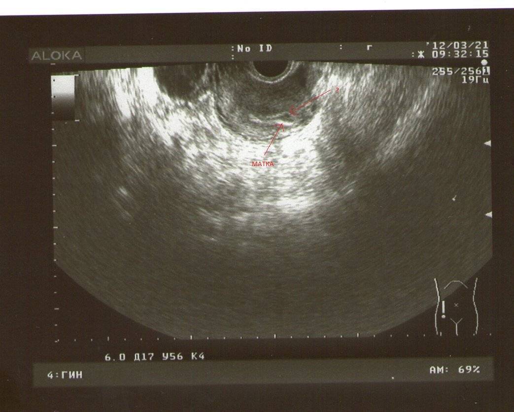 Может ли узи показать беременность на 1 неделе в самом ее начале, что можно увидеть на фото?