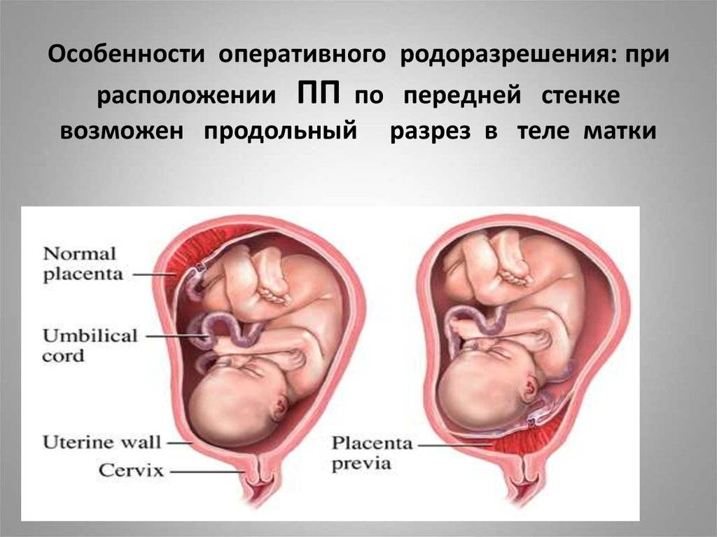 Плацента по задней стенке фото