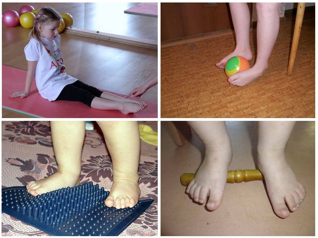 Массаж при вальгусной и плосковальгусной деформации стопы у детей: видео