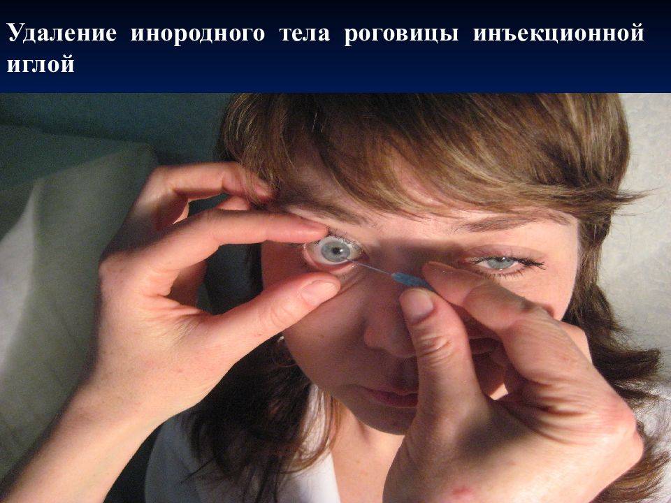 Что делать, если соринка попала под верхнее веко и как её правильно вытащить