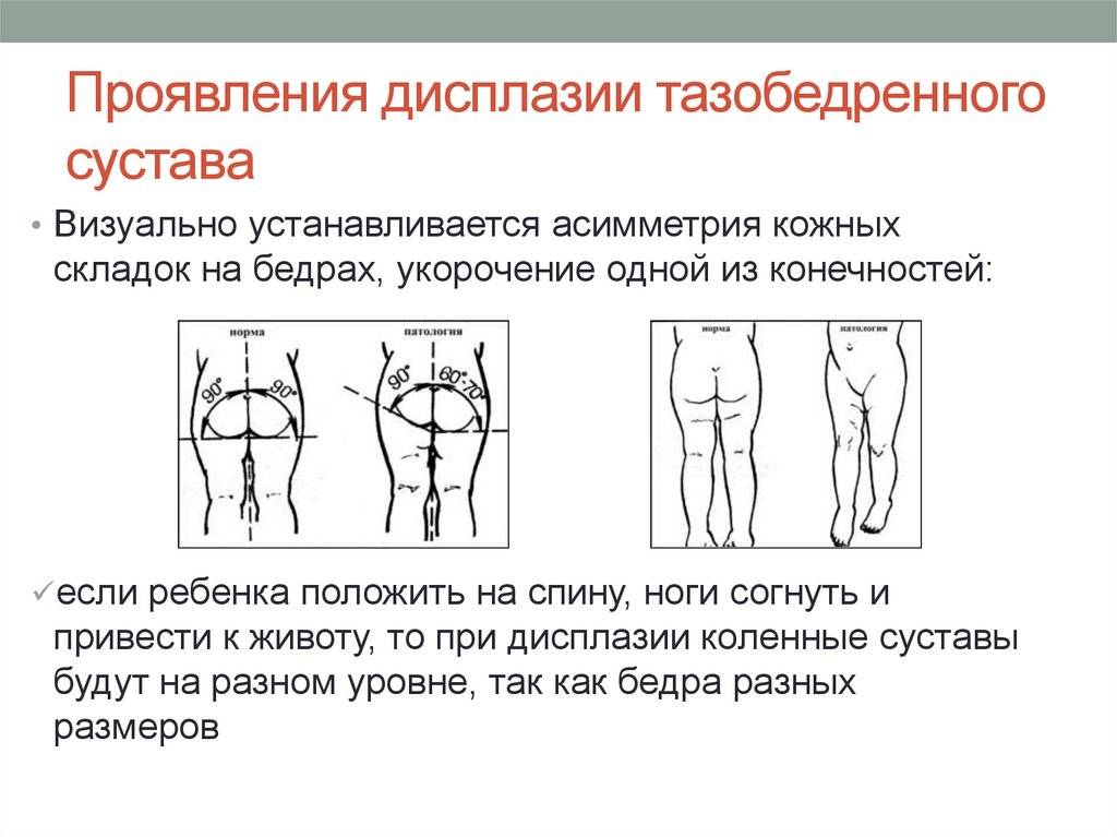 Дисплазия тазобедренных суставов у детей от а до я: почему возникает, как выявляется, проверенные способы лечения
