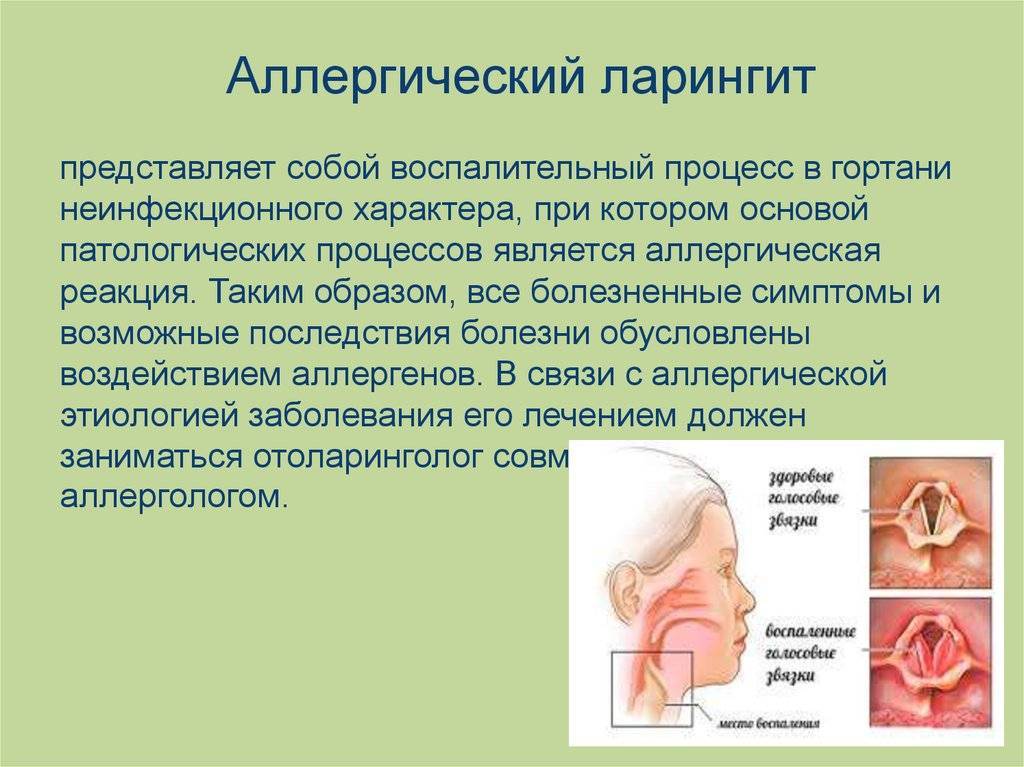 Острый ларингит у детей