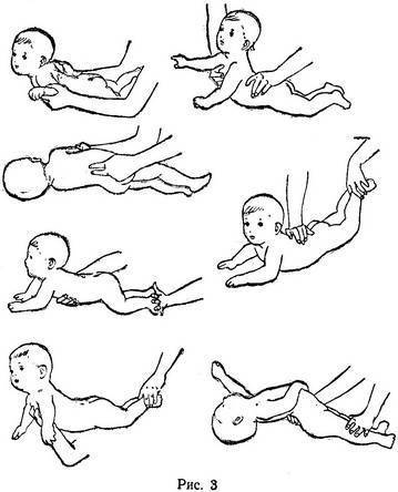 Установочная левосторонняя и правосторонняя кривошея у новорожденных и грудничков