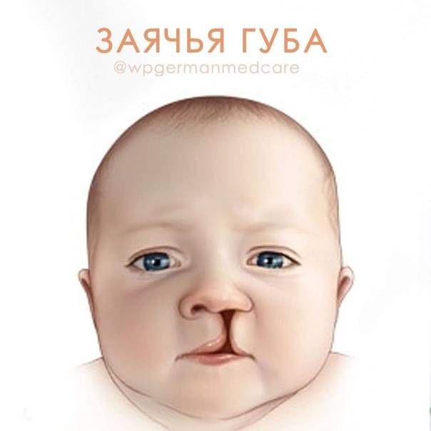 Заячья губа и волчья пасть: причины, фото детей до и после операции | pricemedic.ru