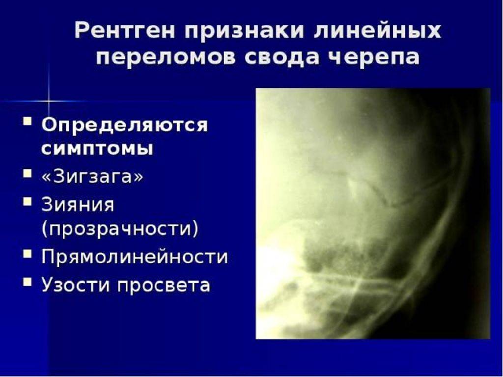 Черепно-мозговая травма