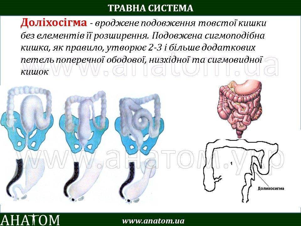 Долихосигма кишечника что это такое у взрослых симптомы лечение фото