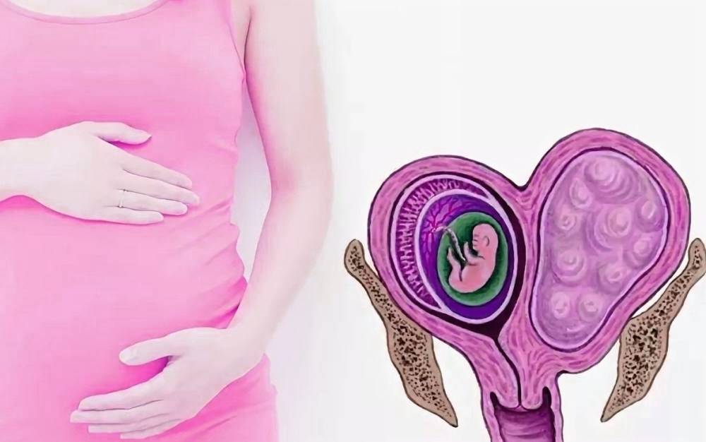 Опущение матки и беременность