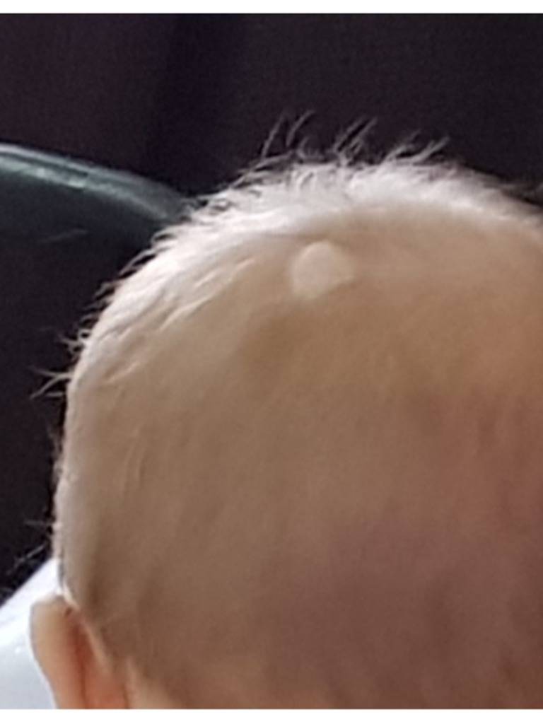 Почему плохо растут волосы на голове. Лысина на затылке у грудничка. У ребенка плохо растут волосы на голове. Корочки на голове у ребенка.