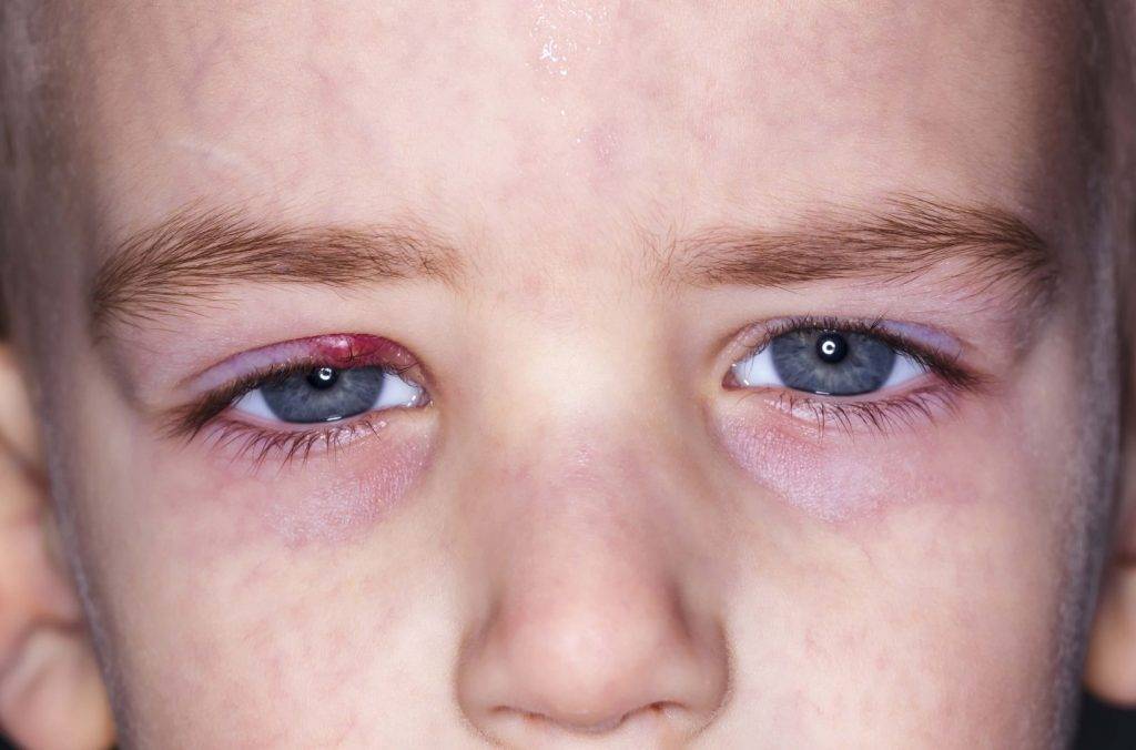 Аллергический конъюнктивит у детей - симптомы болезни, профилактика и лечение аллергического конъюнктивита у детей, причины заболевания и его диагностика на eurolab