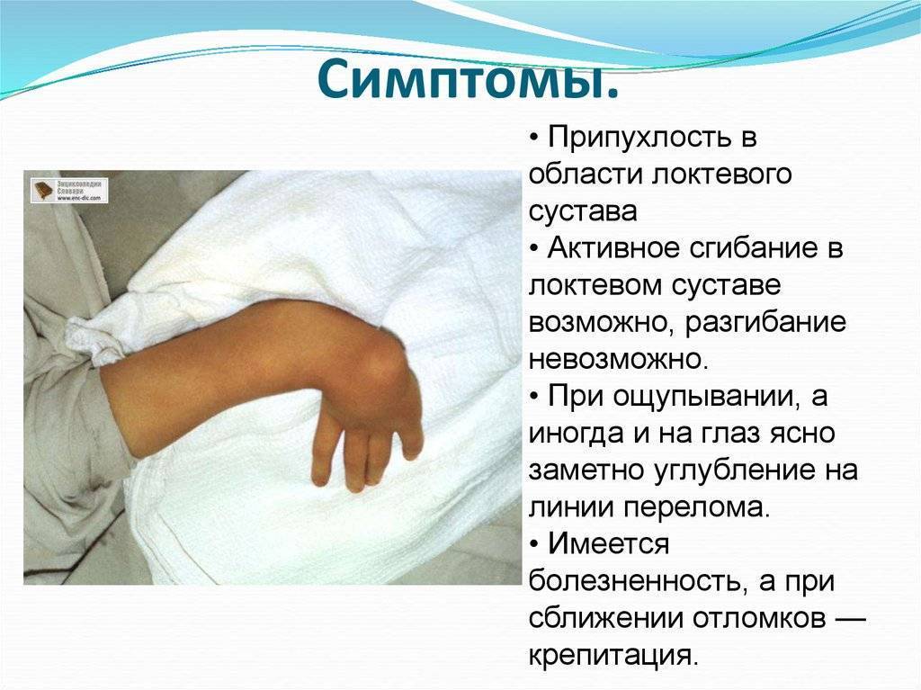 Перелом руки у ребенка: как определить, симптомы и лечение