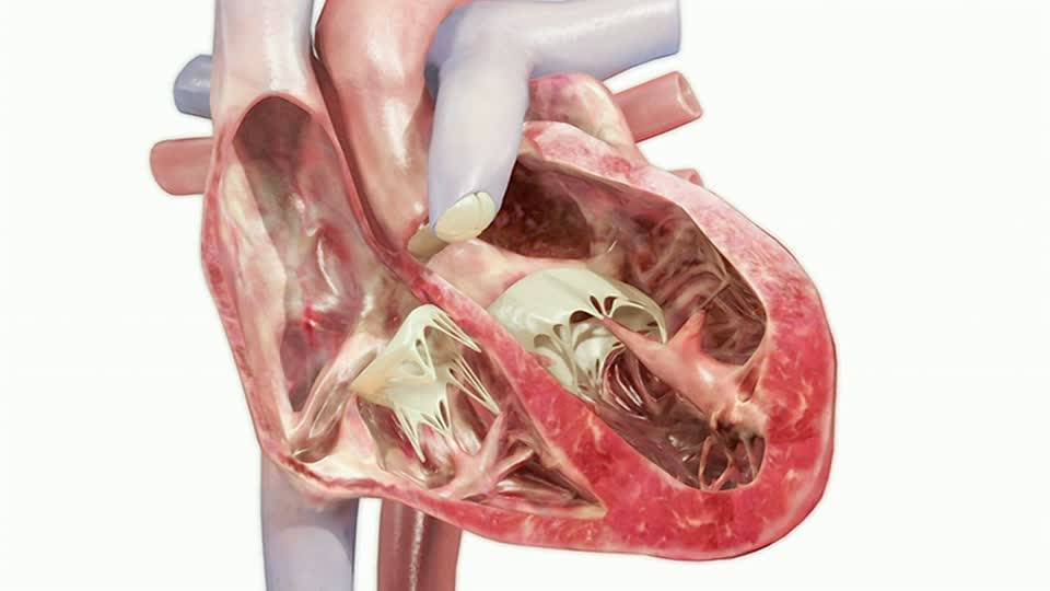 Наличие хорды у человека. Хорда в желудочке сердца. Хорда левого желудочка сердца. Фальшхорда левого желудочка что такое. Дополнительная хорда левого желудочка.