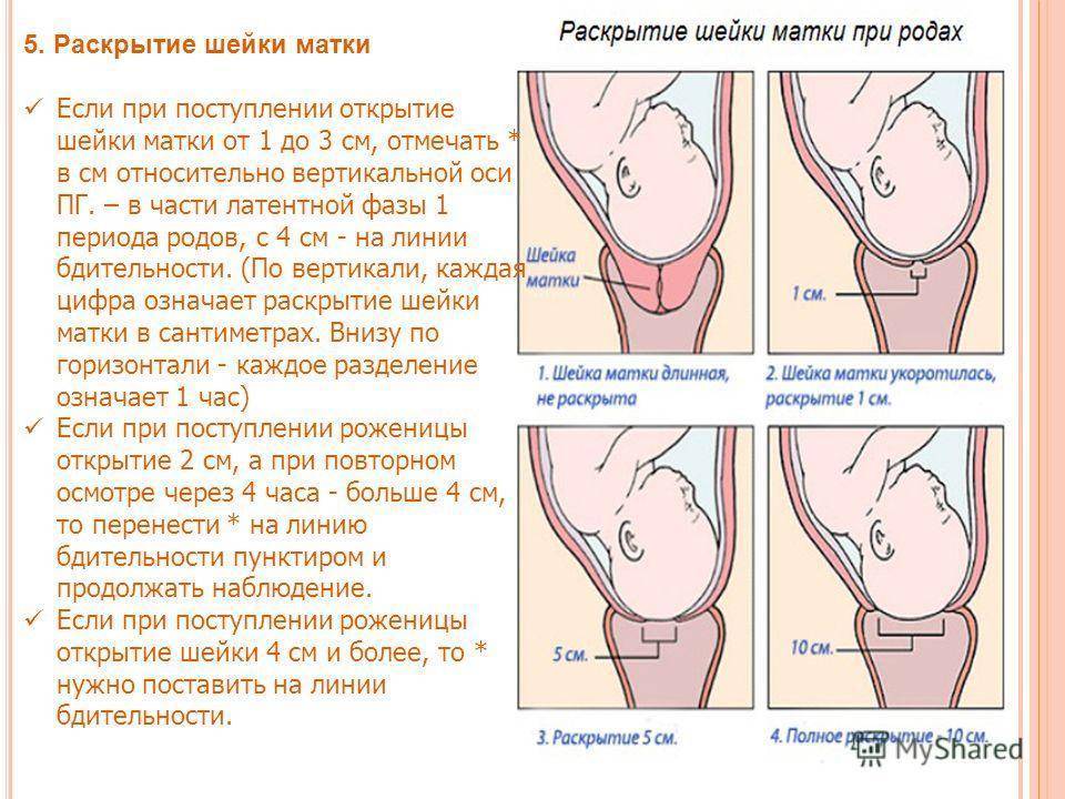 Катетер фолея для раскрытия шейки матки перед родами: показания и порядок проведения процедуры