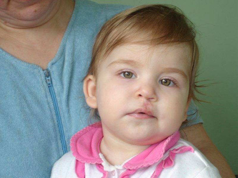 Пороки развития челюстно-лицевой области эмбриона на узи