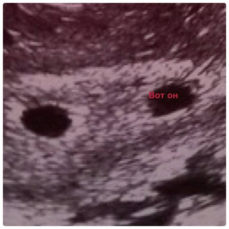 Эмбрион не визуализируется: что это значит, почему на 5–6 неделе беременности не видно зародыша?