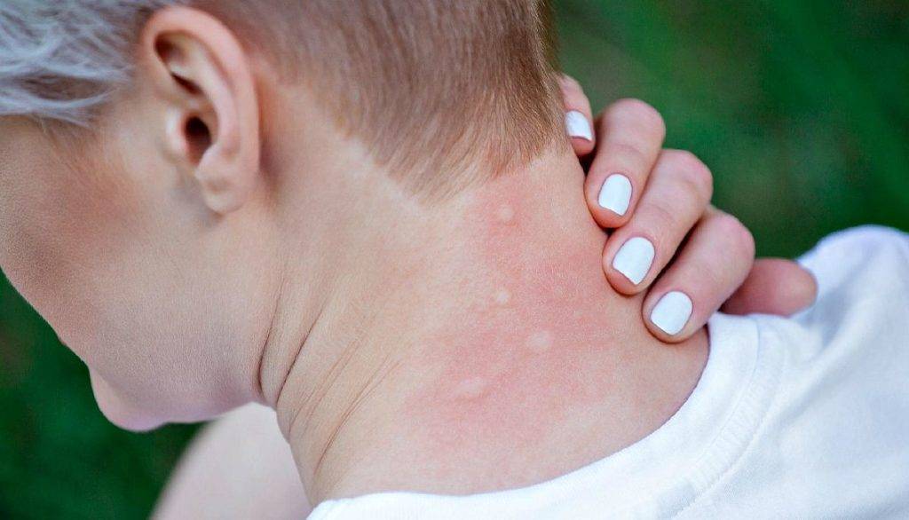 Аллергический дерматит у детей и взрослых: симптомы, диагностика, лечение