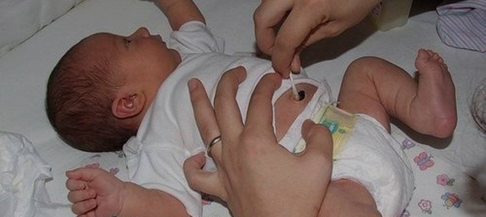 Почему у новорожденного может быть. Омфалит новорожденных омфалит. Пупочная ранка у новорожденного. Пупок новорожденного с прищепкой.