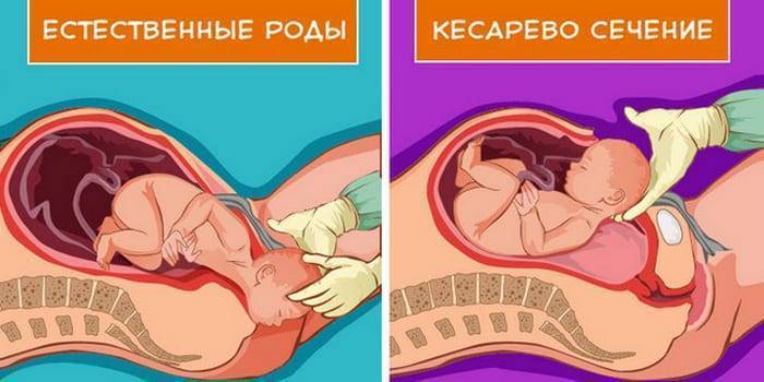 Эко после кесарева сечения: можно ли делать - статья репродуктивного центра «за рождение»