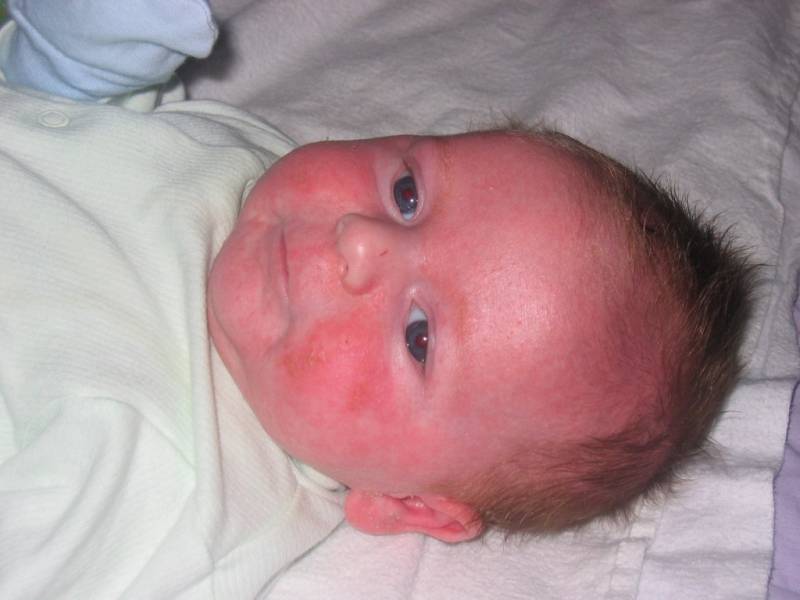 Красные пятна на лице у новорожденного ребенка