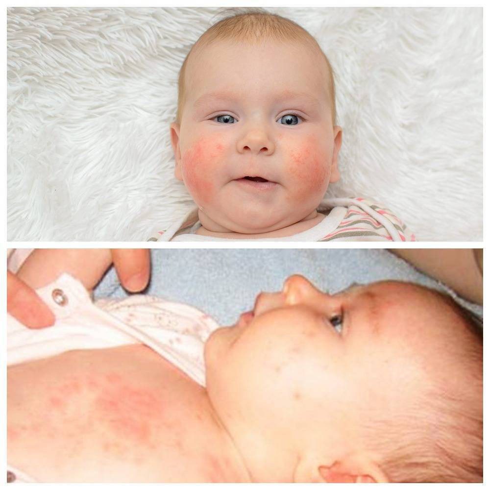 Раздражение на коже у ребенка: причины и эффективные средства