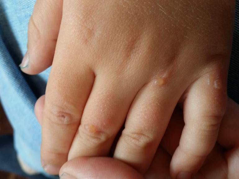 Сыпь на ладонях у ребенка – причины и лечение