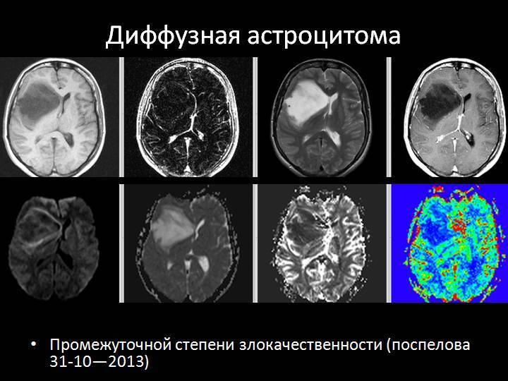 Доброкачественные опухоли головного мозга: симптомы и лечение хондром, менингиом и опухолей мозга других типов