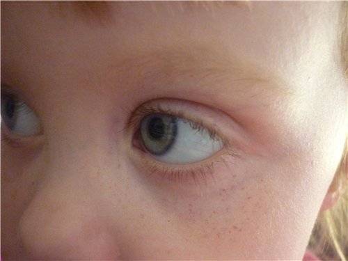 Тёмные круги и синяки под глазами - причины возникновения и методы коррекции.