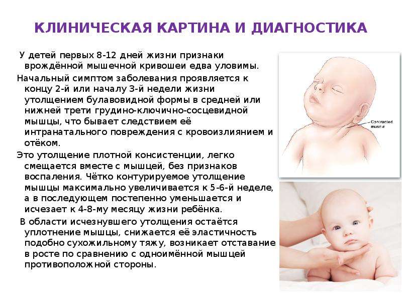 Лечение кривошеи у новорожденных: признаки, как лечить у грудничков в 3 месяца