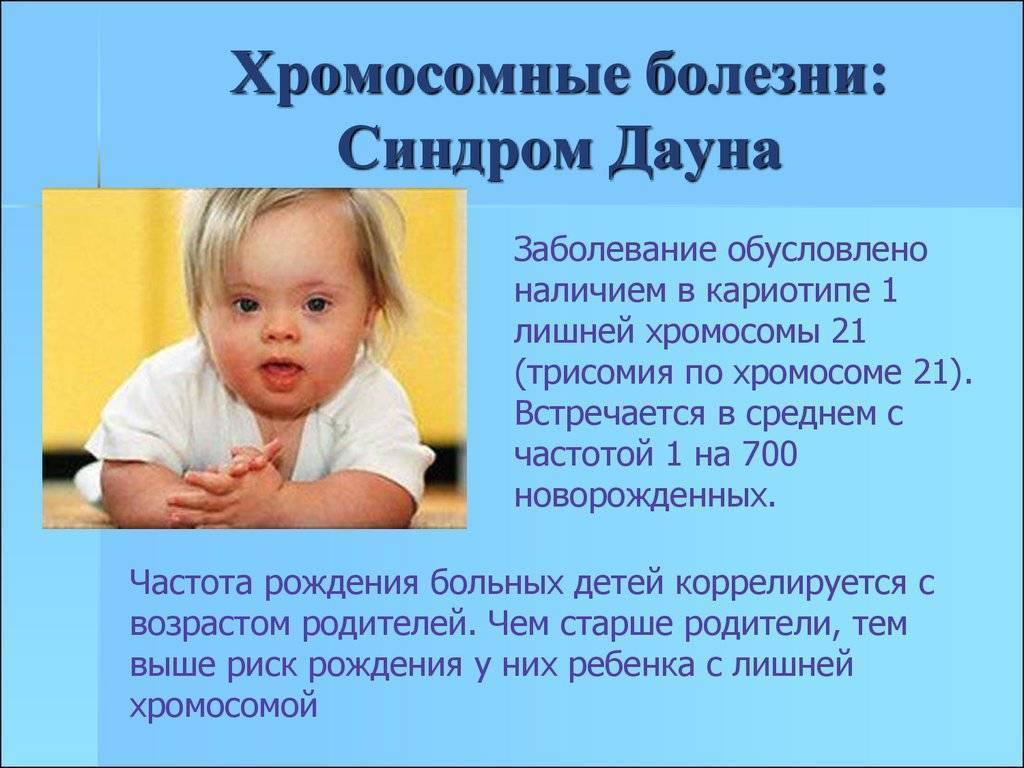 Дети с синдромом Дауна: причины, признаки, симптомы у новорожденных