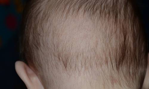 Волосы у ребенка на затылке не растут, стираются - что делать и как решить проблему, к какому врачу обращаться и можно ли справиться самостоятельно в домашних условиях