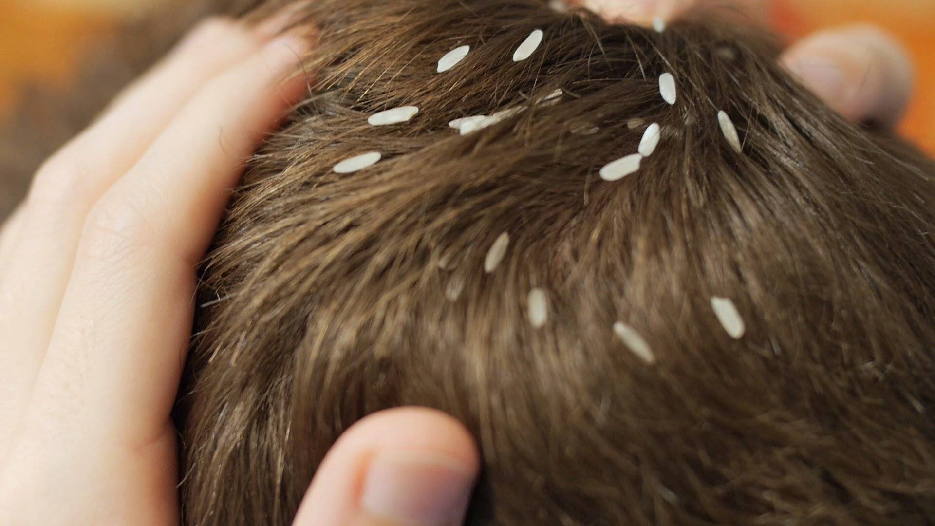 Как лечить волосы глисты
