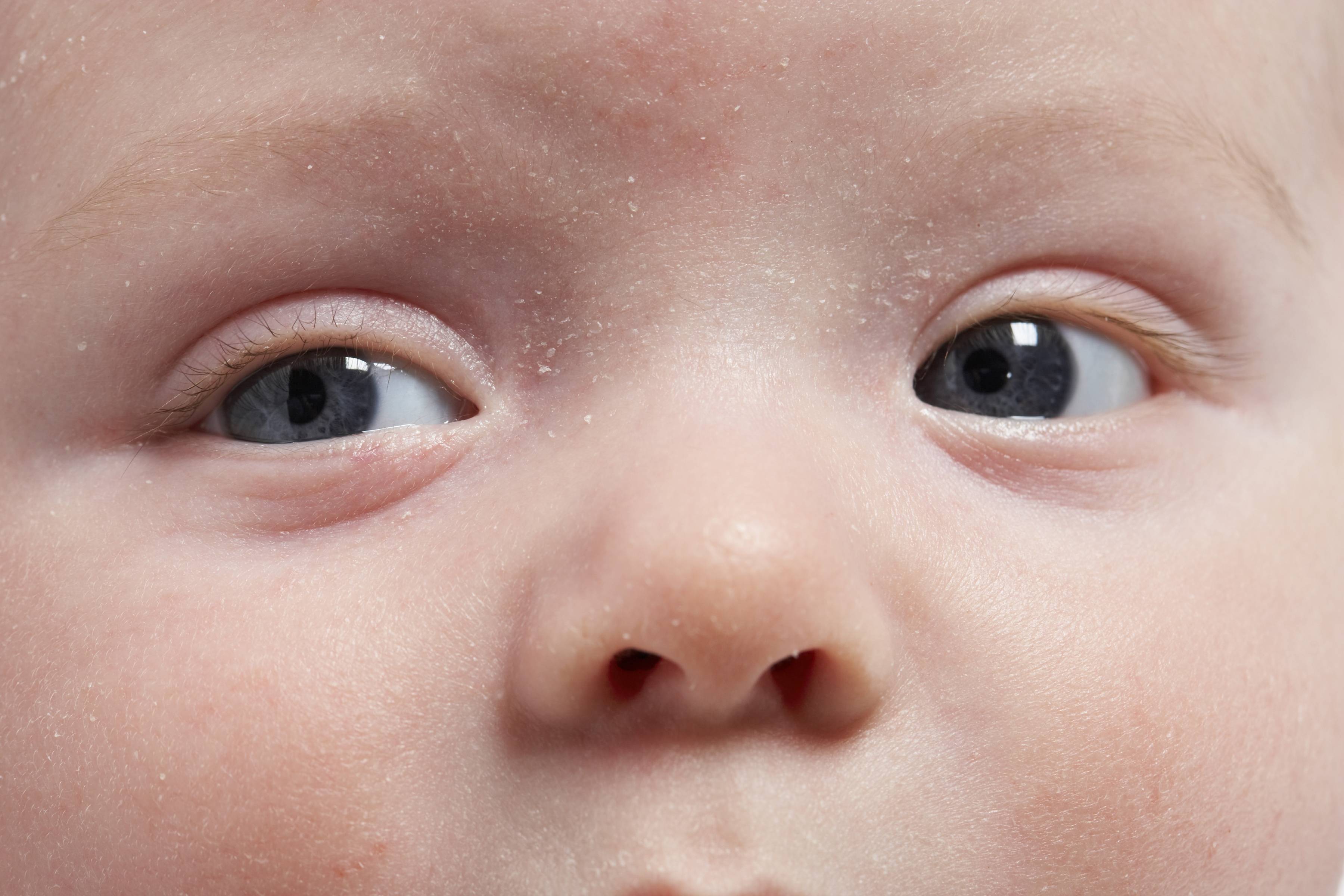 Аллергия на подгузники: как выглядит и что делать | сыпь и покраснения под подгузником у ребенка